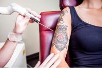 Laser Tattoo Removal Leicester image 11